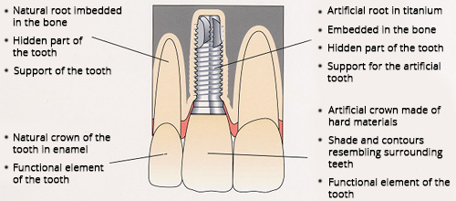 What is an implant? - Dr. Frederic Diener